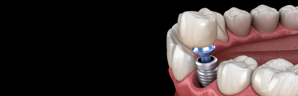 Εμφυτεύματα δοντιών. Η μόνιμη λύση για… πλήρες χαμόγελο!