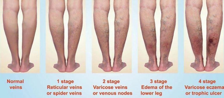 Laser Surgery For Piles, Fistula, Varicose Veins, Varicocele